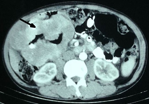 Contrast CT showing multiple, lobulated enhancing jejunal mesenteric GIST, which mimicked aneurysmal-like dilated (arrow), thickened hepatic flexure of colon.