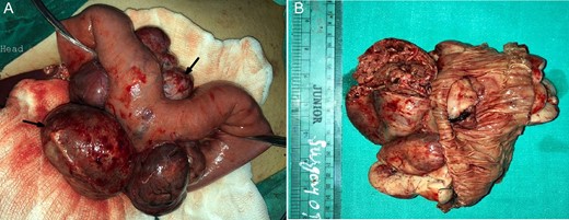 Intraoperative (A) and cut-section (B) view of solid, lobulated (arrow) and necrotic changes in the E-GIST arising from the jejunal mesentery.