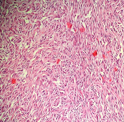 Photomicrograph (H&E,×100) showing proliferation of spindle to epitheloid tumor cells in sheets and nests.