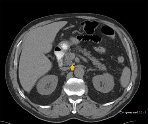 CT scan depicting a 2.5 cm mass (arrow) with calcification in the head of pancreas.