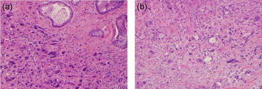 Post-operative histopathological features—(a) atypical giant cells with marked nuclear pleomorphism. (b) Desmoplastic stroma with markedly atypical giant cells with marked nuclear pleomorphism.