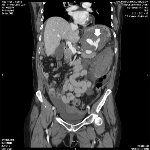 Computed tomography showed three saccular splenic artery aneurysms with a large left upper quadrant hematoma (block white arrow) and blush from distal splenic aneurysm.