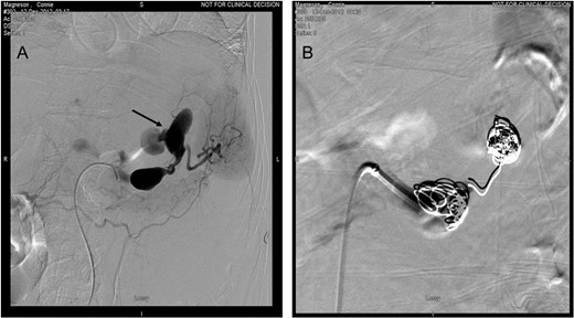(A) Visceral angiography revealed extravasation from distal saccular aneurysm (arrow). (B) Embolization of the aneurysm was done by using Nester coils.