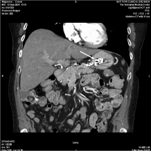 Computed tomography showing a migrated coil (arrow) in the lumen of stomach.