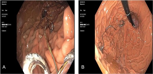 (A) Endoscopy showed wire strands in the fundus of the stomach and (B) occluding the pylorus.