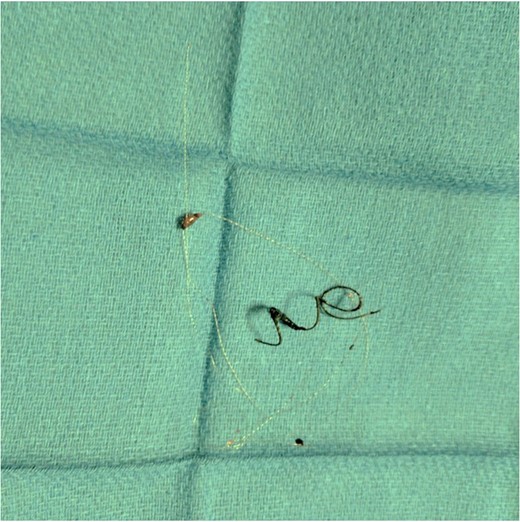 Endoscopic retrieval of coils assisted with laparoscopic visualization of lesser sac.