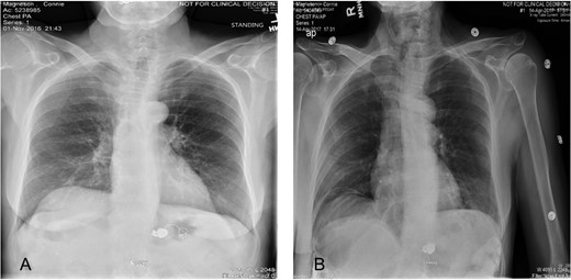 (A) Plain abdominal radiograph comparing preoperative migrated coil into the stomach. (B) Postoperative film showing coil successfully retrieved.