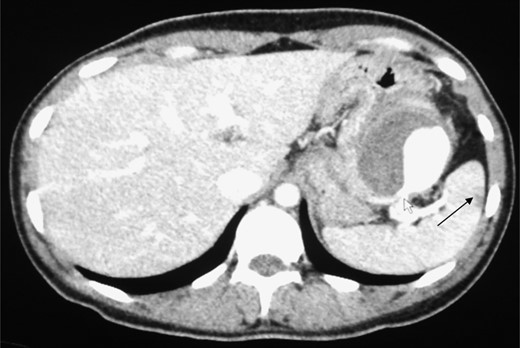 CT image showing the ‘ying yang’ sign of the SAA. White arrow shows the origin from the splenic artery. Black arrow shows a splenic infarct.