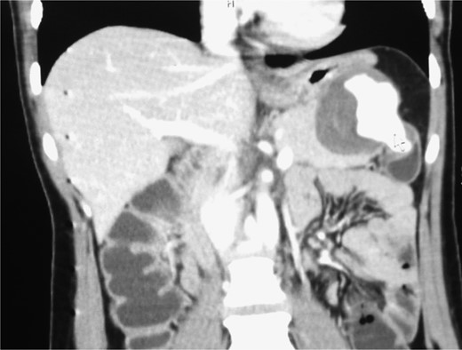 CT shows the point of communication (free rupture) between the aneurysm and splenic flexure of the colon.