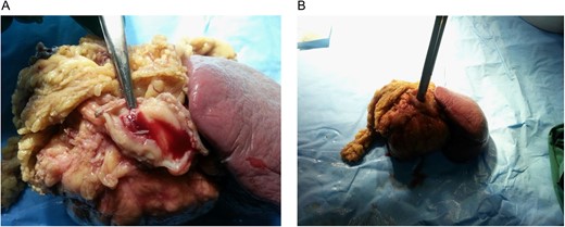 En-bloc specimen. (A) Hemorrhage into the colonic lumen from the aneurysmal communication. (B) The specimen showing free rupture of the aneurysm into the colonic lumen.