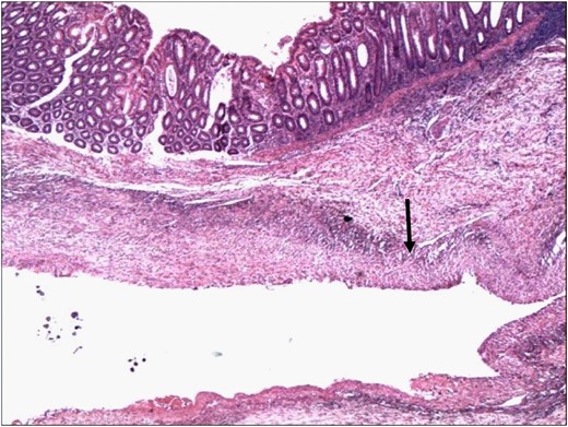 Wall of the colon showing attenuation and loss of the muscle layers. The wall of the aneurysm is indicated by the arrowhead (H&E 4×).