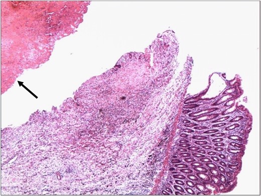 Point of rupture of the aneurysm into the lumen of the colon. The lumen of the aneurysm contains blood clot (arrowhead) (H&E 4×).