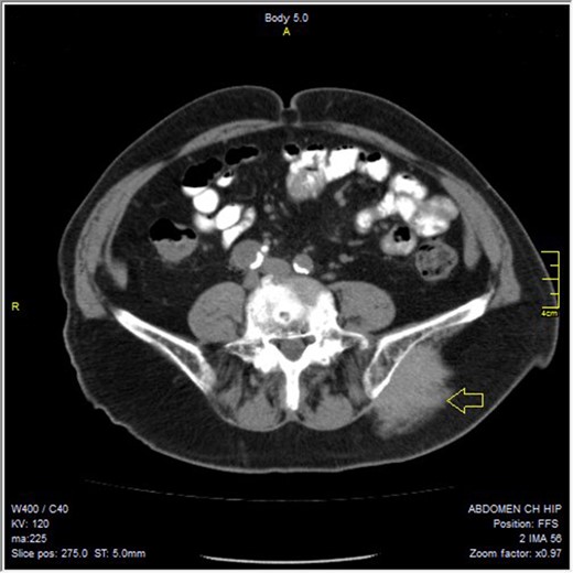 The tumor on CT scan.