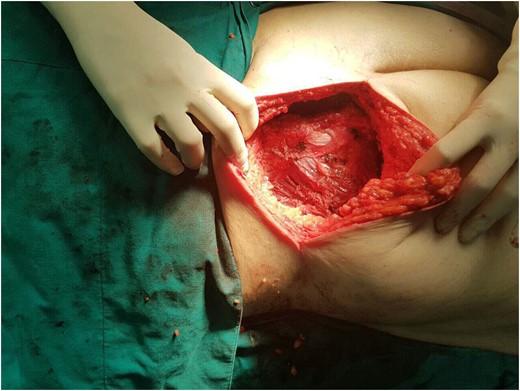 The tumor within the gluteal muscles.