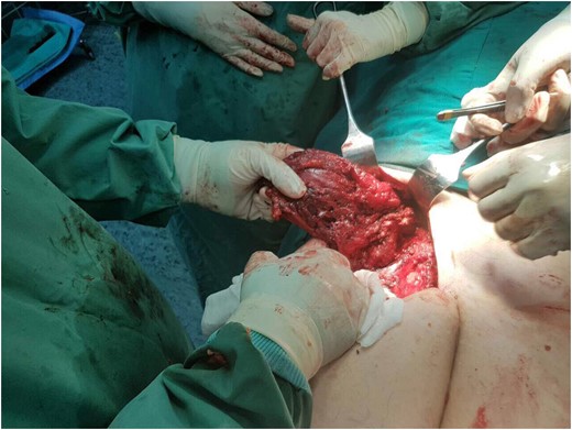 The wide excision of the portion of the gluteus maximus and medius muscle.