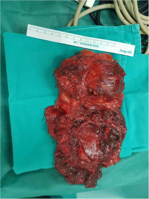 The specimen as removed.