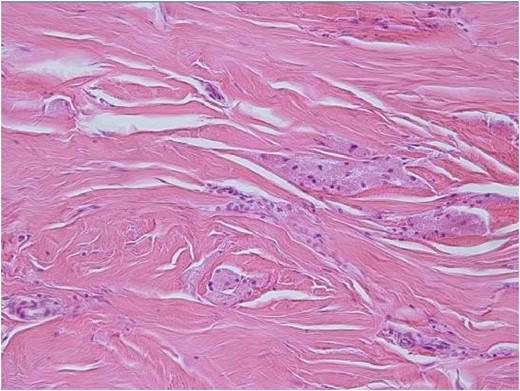 H-E ×200: On medium power examination tumor cells are separated by fine sclerotic collagenous tissue.