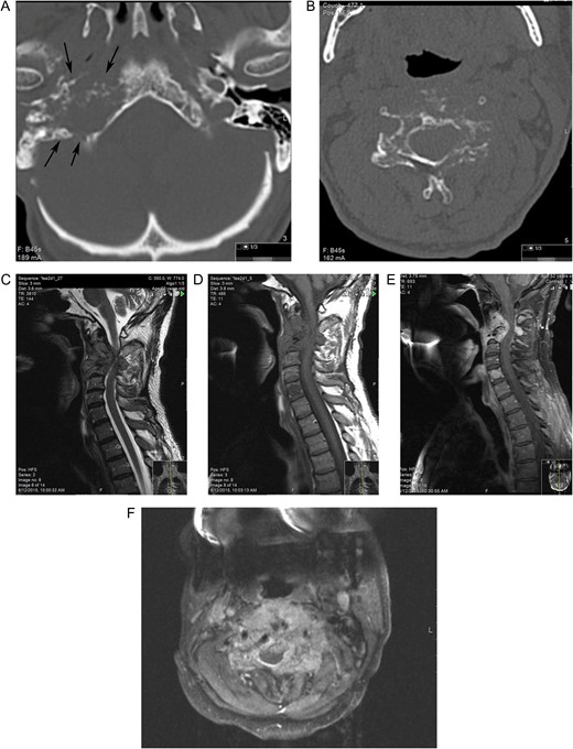(A) CT shows a destructive lesion in right petrous bone arising at the level of jugular bulb extending anteriorly to the carotid canal (arrow) (B) CT at the level of C3 reveals mottled osteolytic lesion with destruction of the vertebral body and involvement of posterior elements. MRI demonstrates the lesion to be hypointense on sagittal T1-weighted image (C) isointense on T2-weighted (D) and with avid enhancement on post-contrast sagittal (E) and axial (F) TI fat-sat images and epidural extension of the tumor with spinal cord compression. Note avid enhancement of the metastatic lesion of C5 vertebrae body as well.
