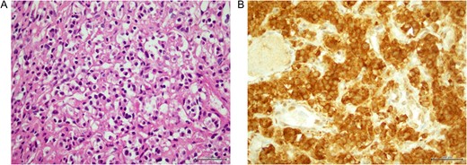(A) Osteolytic invasion by paraganglioma (B) tumor cells expressing chromogranin A.