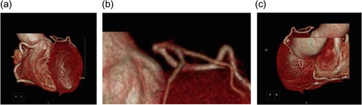 Coronary angiography at the time of the initial diagnosis. (a and b) Anterior-left lateral image and (c) posterior-right lateral view. The disruption of blood flow to the LMT can be seen. Despite this disruption, the left anterior descending coronary artery and the circumflex artery demonstrate contrast enhancement. There is no indication of calcification or other lesions in the LMT.