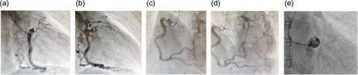 (a and b) Right coronary angiography: right anterior oblique projection; (c and d) right coronary angiography: left anterior oblique projection; (e) left coronary angiography. During left coronary angiography, only the sinus of Valsalva is visualized, and there is no antegrade contrast enhancement in the left coronary artery. The left coronary artery is visualized through collateral pathways from the right coronary artery. The right coronary artery is more developed than the left coronary artery, and several collateral pathways can be observed.
