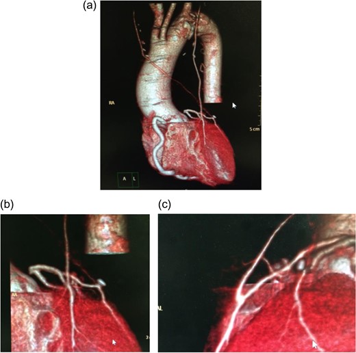 Postoperative coronary angiography. Complete graft patency was confirmed.