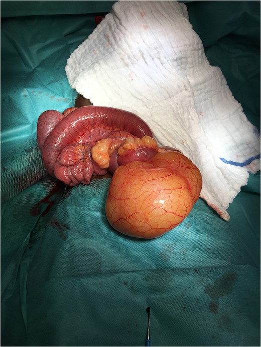 Small bowel strangulation and lipoma.