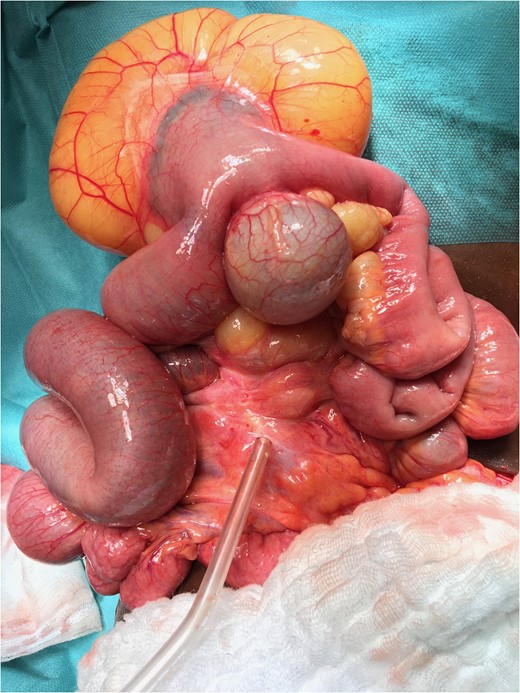 Lipoma and myxoma.