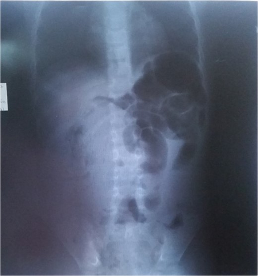 Plain abdominal radiograph.