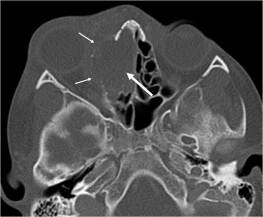 Axial non-contrast CT demonstrating an expansile lesion centred on the right-sided ethmoidal labyrinth (long white arrow) with remodelling of the lamina papyracea (short white arrows).