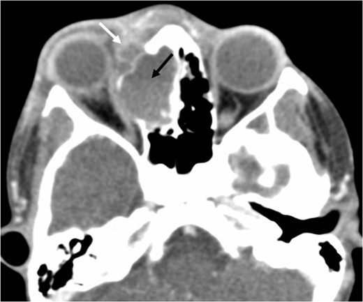 Axial post-contrast CT demonstrating the peripherally enhancing right-sided intra-orbital subperiosteal component. The expansile lesion centred on the right ethmoidal labyrinth demonstrates a faint fluid–fluid level.
