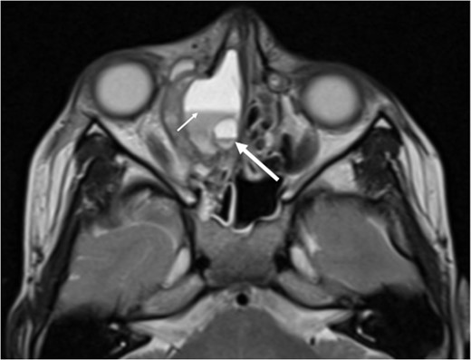 Axial T2 weighted sequence demonstrating the presence of multiple fluid filled levels (short white arrow) within the expansile lesion and smaller cyst present within the larger cyst (long white arrow).