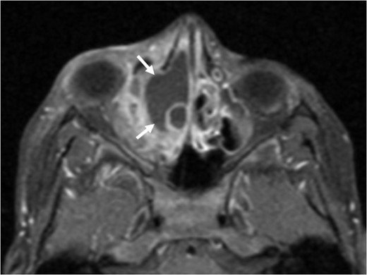 Axial T1 post-contrast sequence with fat suppression demonstrating peripheral enhancement (white arrows) but no internal or solid enhancing components to suggest that this is a secondary ABC.