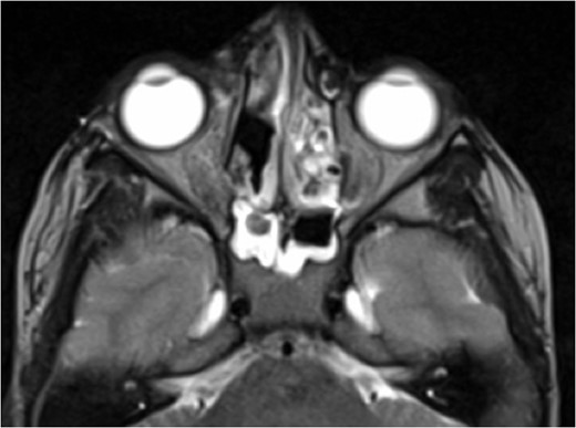 Axial T2 weighted sequence following surgical intervention and medial orbital wall reconstruction for the most recent recurrence demonstrating no residual abnormality.