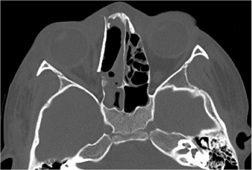 Axial non-contrast CT at the same level demonstrating the resection of the ABC following multiple surgical procedures and a medial orbital wall reconstruction.