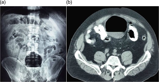 (a) Abdominal X-ray shows an air-filled structure in the lower abdomen (Balloon-sign). (b) Abdominal CT scan shows an air-filled cavity associated with the colon.