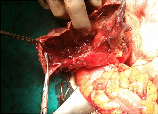 Giant colonic diverticulum on laparotomy.