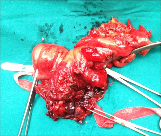 Resected specimen of the giant colonic diverticulum and sigmoid colon.