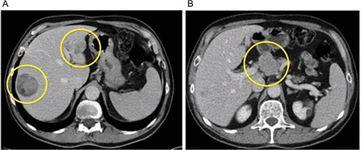 (A) Venus phase of dynamic CT-scan showing two hepatic nodules (classical HCC in S8 and medullary-like HCC in S2) and (B) large lymph node in the coeliac region.