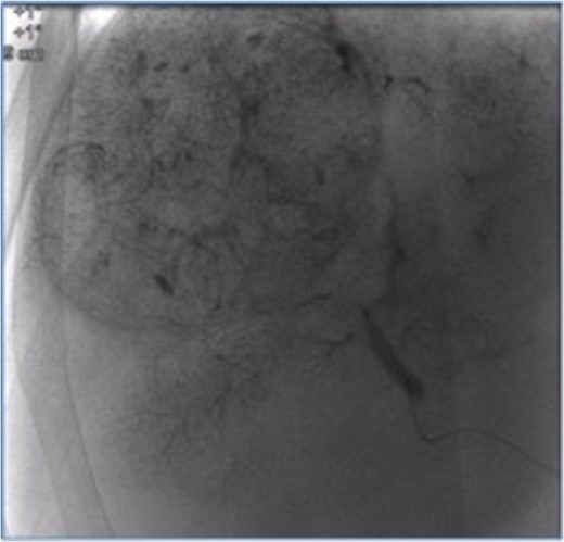 Segment 8 nodule treated with transarterial chemoembolization.