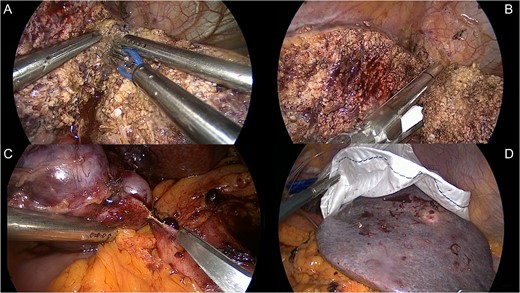 Treatment of Segment 2 nodule: (A) laparoscopic lateral left sectionectomy; (B) left hepatic vein stapling; (C) complete lymphadenectomy with excision of the lymph nodes in the coeliac region; and (D) specimen extraction through a minilaparotomy.