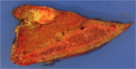 Macroscopic photograph of the operative specimen.