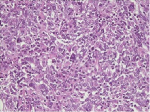 H&E-stained slide, ×50. Large anaplastic cells with enlarged vesicular nuclei, prominent nucleoli and numerous mitoses.