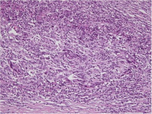 H&E-stained slide, ×50. Periphery of the tumor with dense lymphoplasmacytic infiltrate.