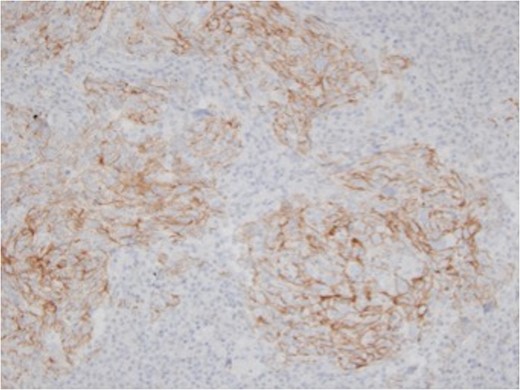 Immunohistochemistry for β-catenin, ×50. The tumor cells showed membranous staining for β-catenin.