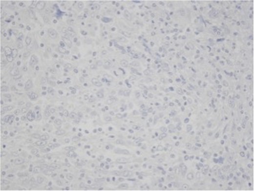 Immunohistochemistry for HEP, ×50. The tumor cells showed negativity for HepPar.