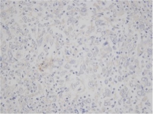 Immunohistochemistry for CK 7, ×50. The tumor cells showed negativity for cytocheratin 7.