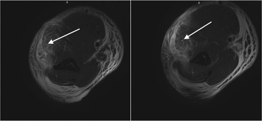 White arrows: high-grade muscle strain of the muscles the dorsal compartment with extensive soft tissue edema throughout the arm.