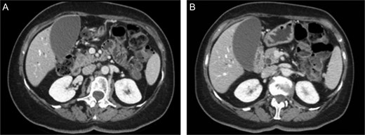 MDCT scan. (A) CT scan with well-defined hypodense pancreatic head mass of 2 cm of diameter after contrast medium intravenous injection. (B) CT scan which highlight bile duct dilatation.