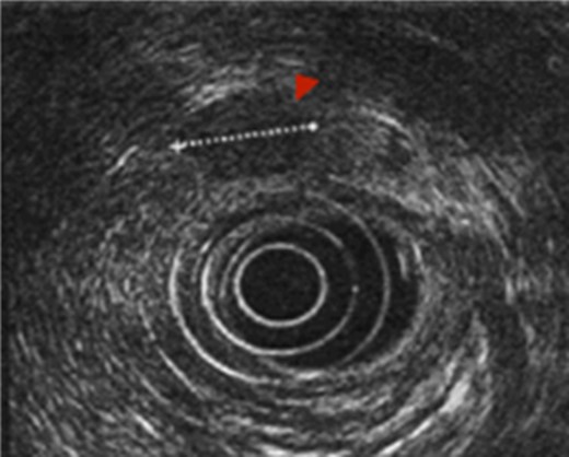 EUS. EUS confirmed the presence of a hypoechoic and well-defined mass of diameter 18 × 15 mm.